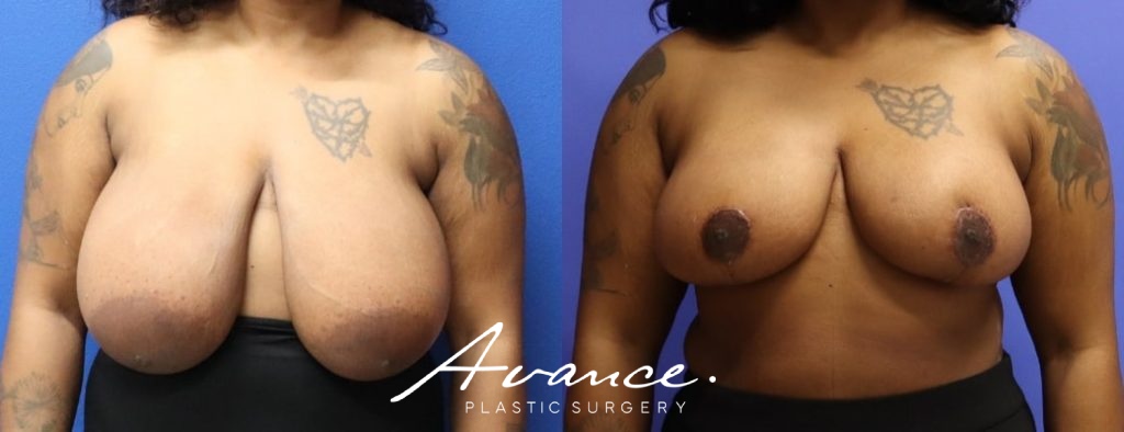 Before and After - Breast Reduction