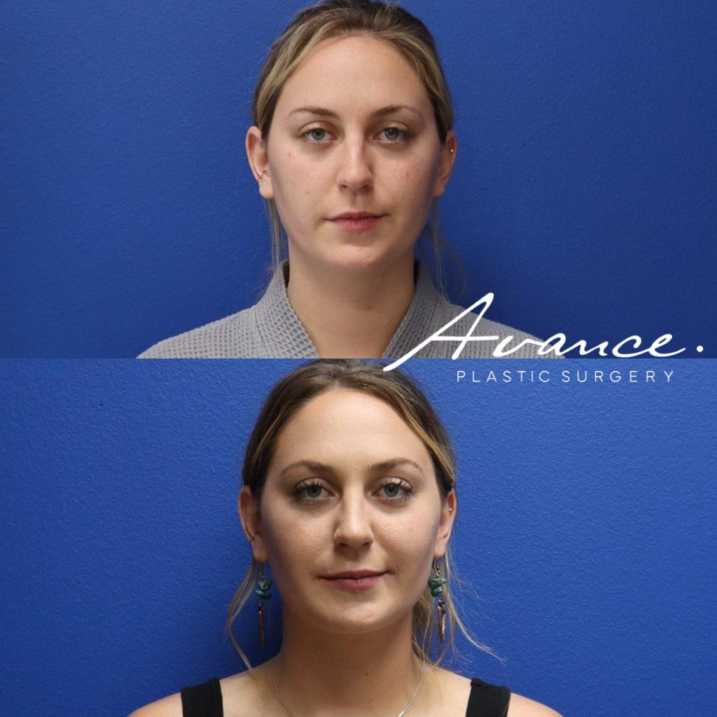 Before and After - Eliminación de la grasa bucal