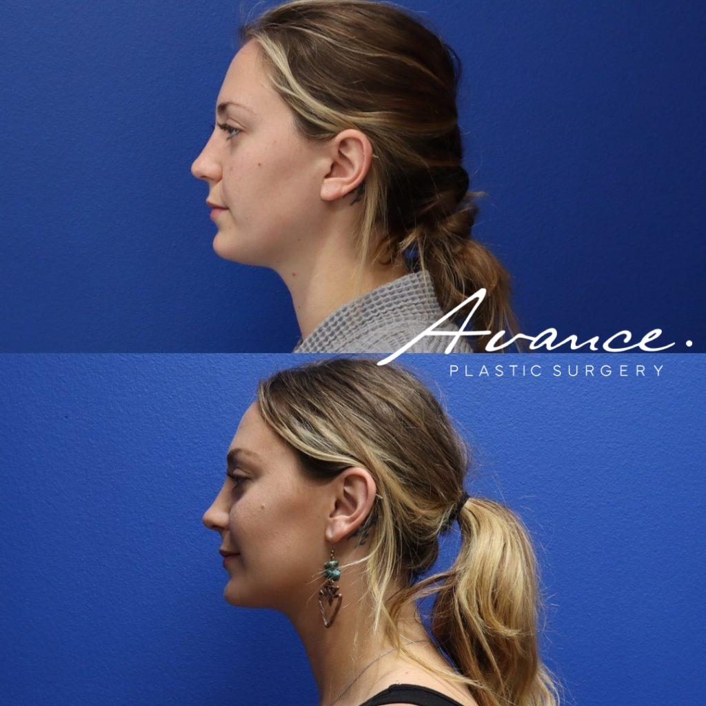 Before and After - Eliminación de la grasa bucal