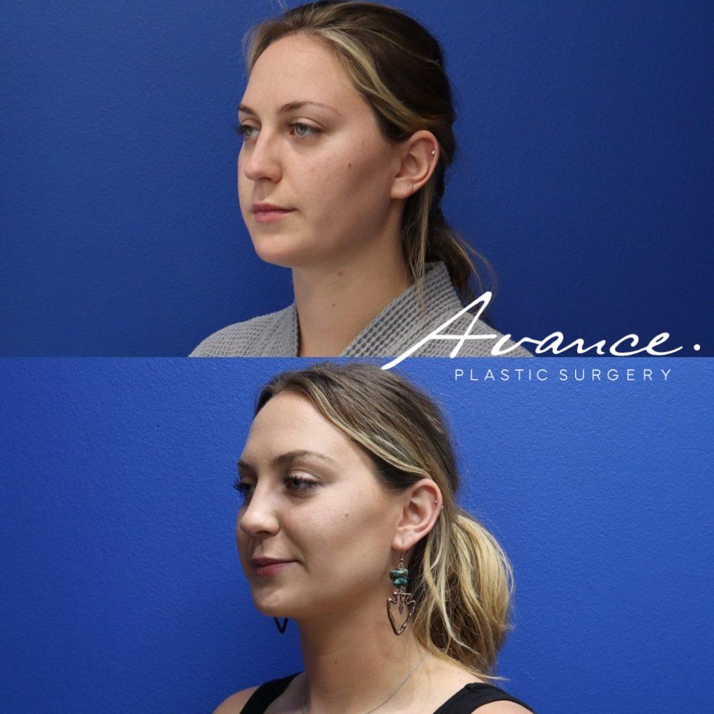 Before and After - Eliminación de la grasa bucal