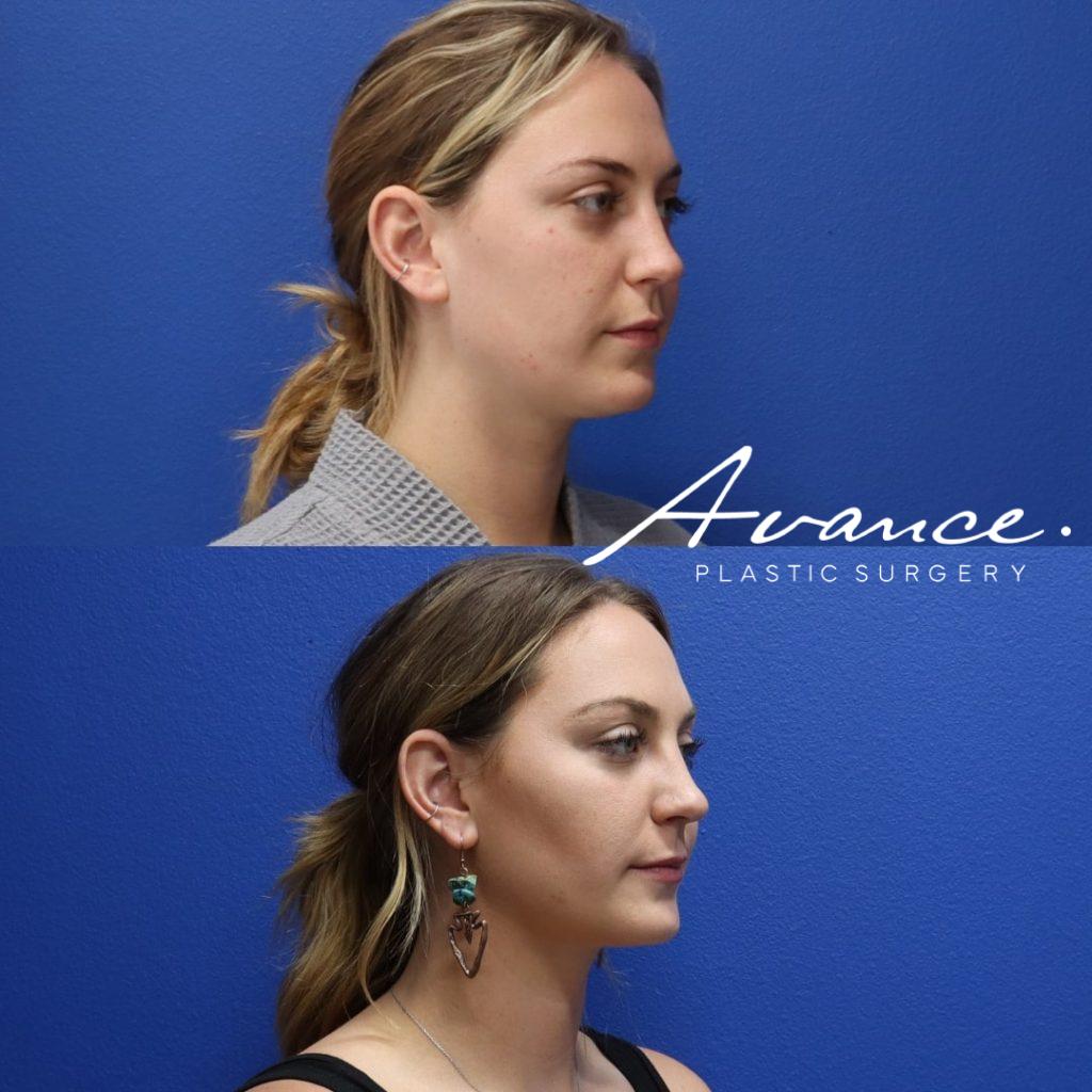 Before and After - Eliminación de la grasa bucal