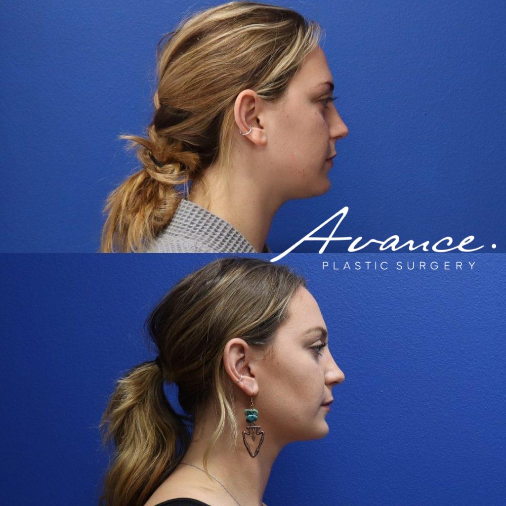 Before and After - Eliminación de la grasa bucal