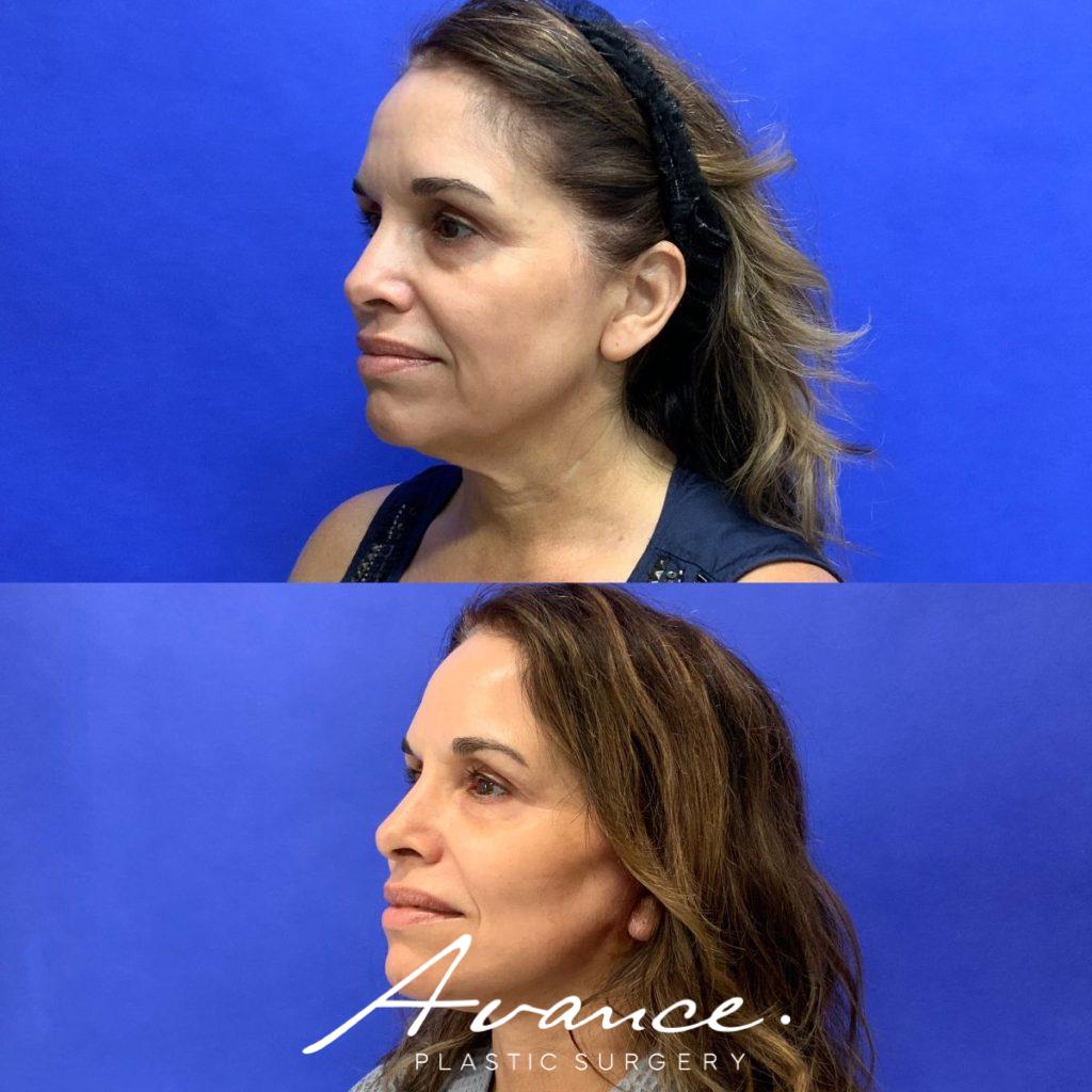 Before and After - Facelift/Necklift & Minifacelift/Necklift