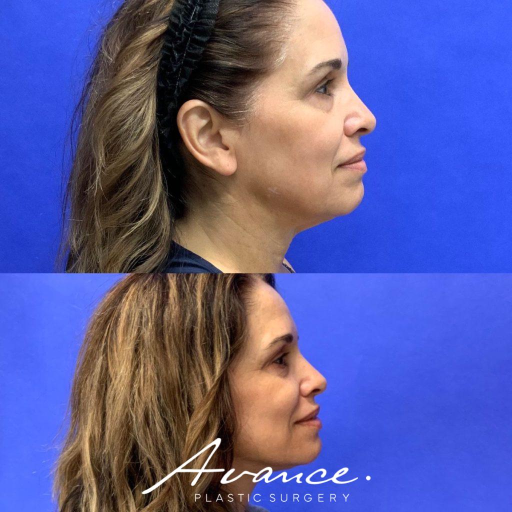 Before and After - Facelift/Necklift & Minifacelift/Necklift