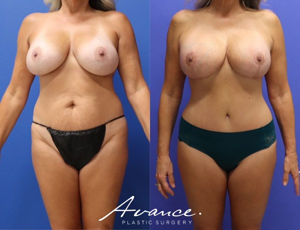 Before and After - Mommy Makeover