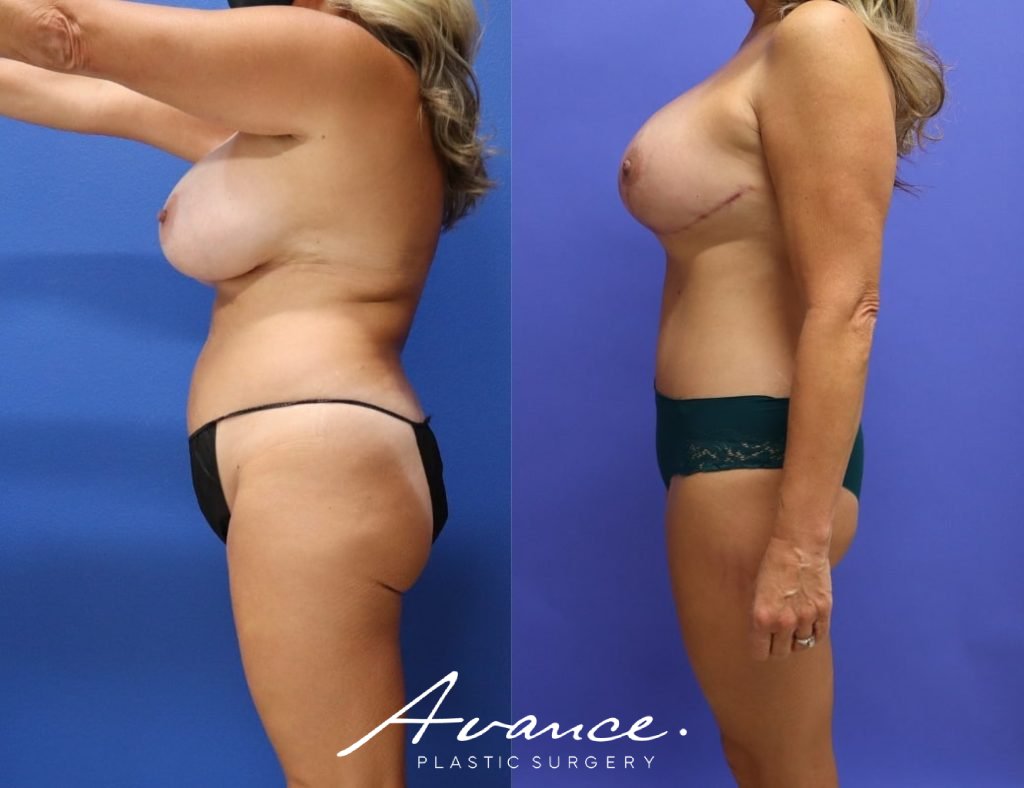 Before and After - Mommy Makeover