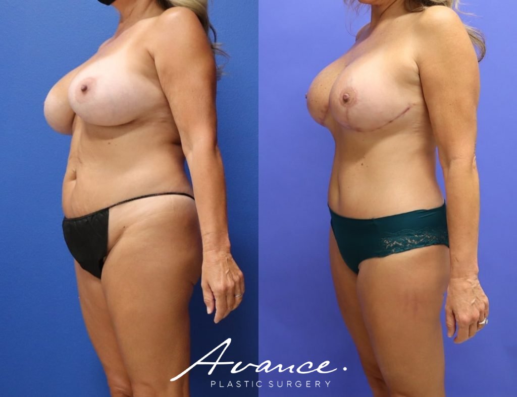 Before and After - Mommy Makeover