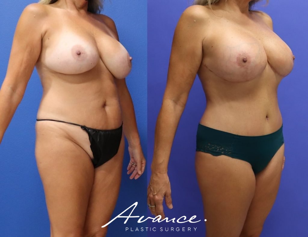 Before and After - Mommy Makeover