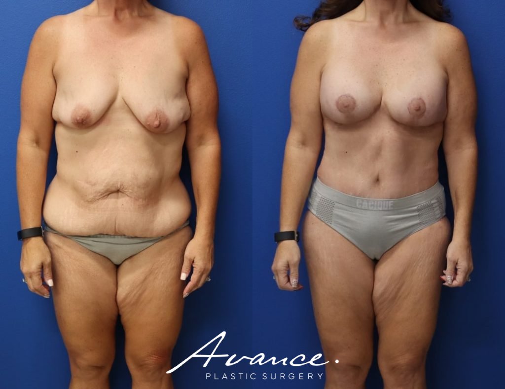 Before and After - Mommy Makeover