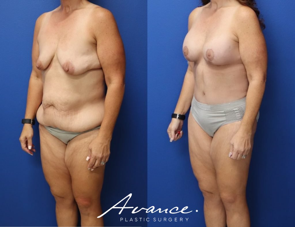 Before and After - Mommy Makeover