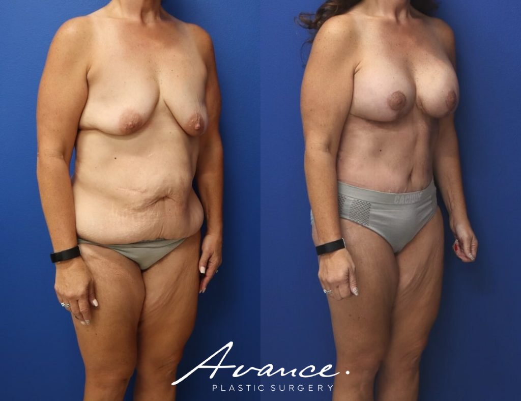 Before and After - Mommy Makeover