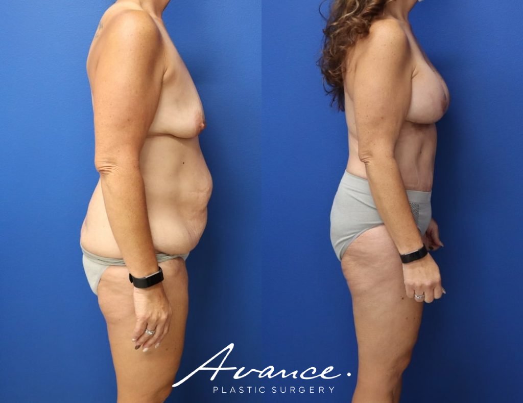 Before and After - Mommy Makeover