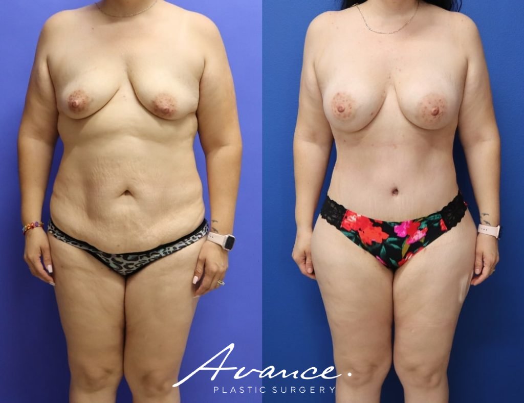 Before and After - Mommy Makeover