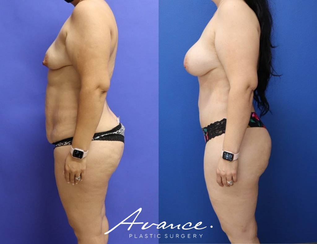 Before and After - Mommy Makeover