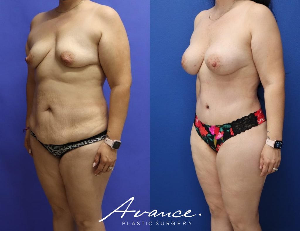 Before and After - Mommy Makeover