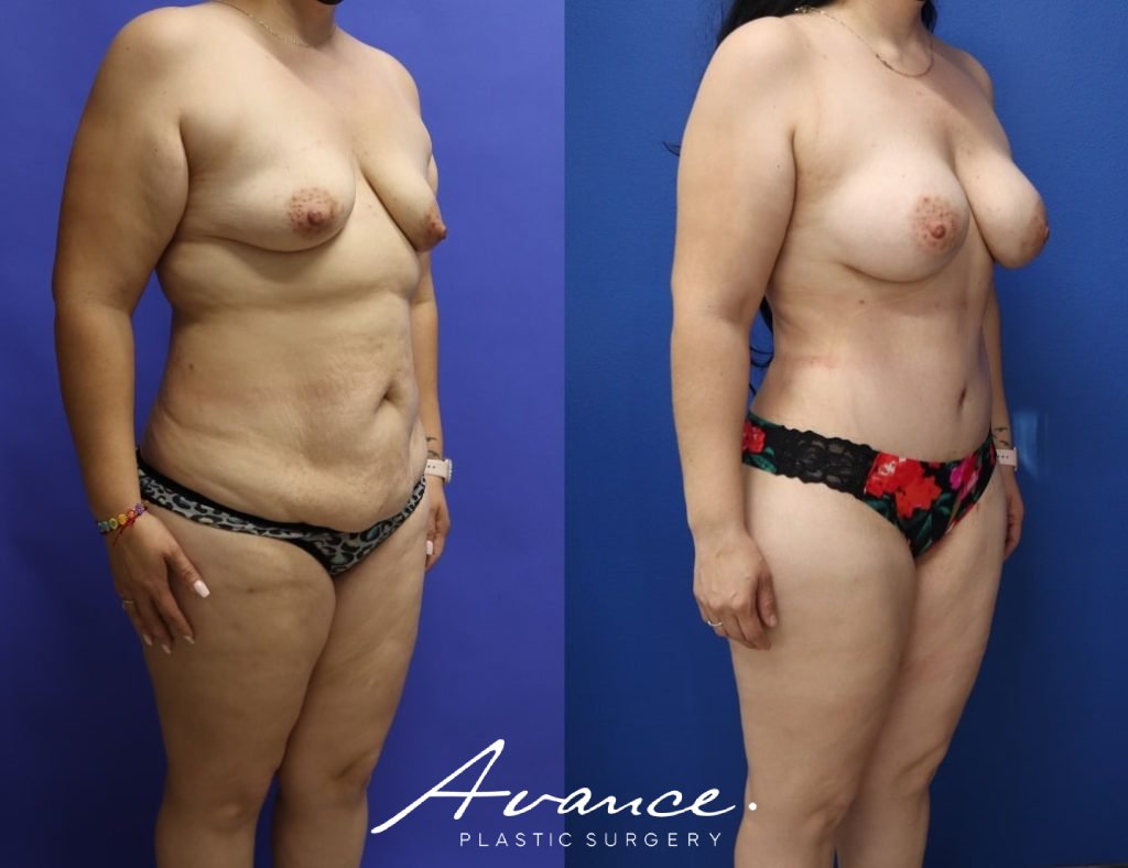 Before and After - Mommy Makeover