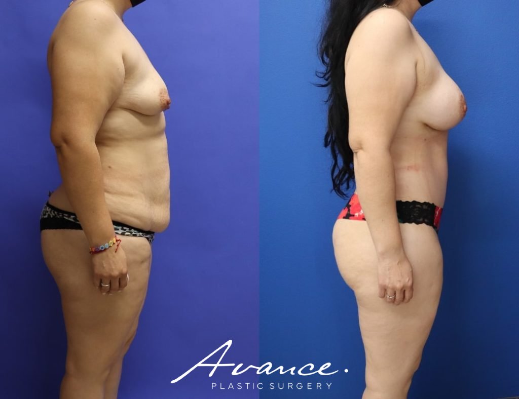 Before and After - Mommy Makeover
