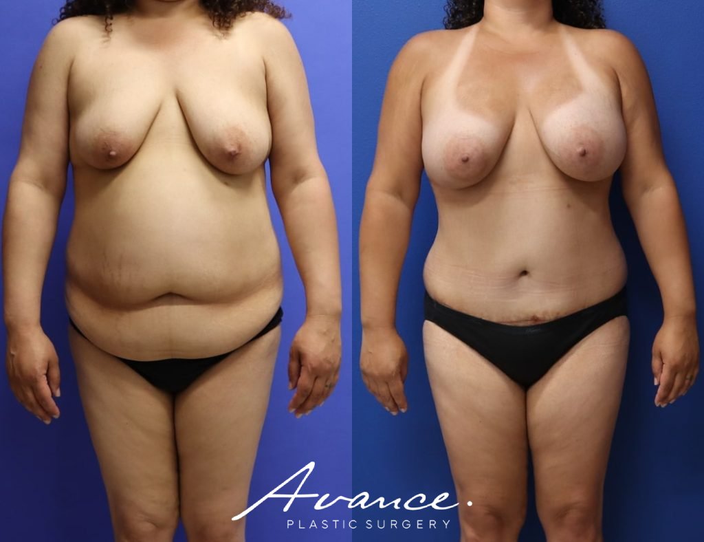 Before and After - Mommy Makeover