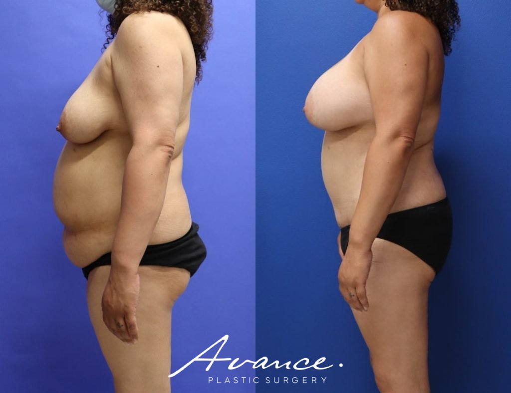 Before and After - Mommy Makeover