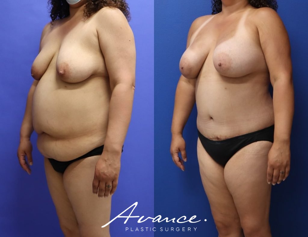 Before and After - Mommy Makeover