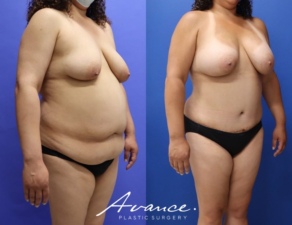 Before and After - Mommy Makeover