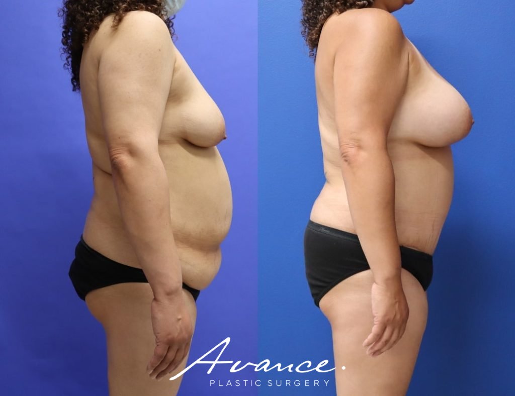 Before and After - Mommy Makeover