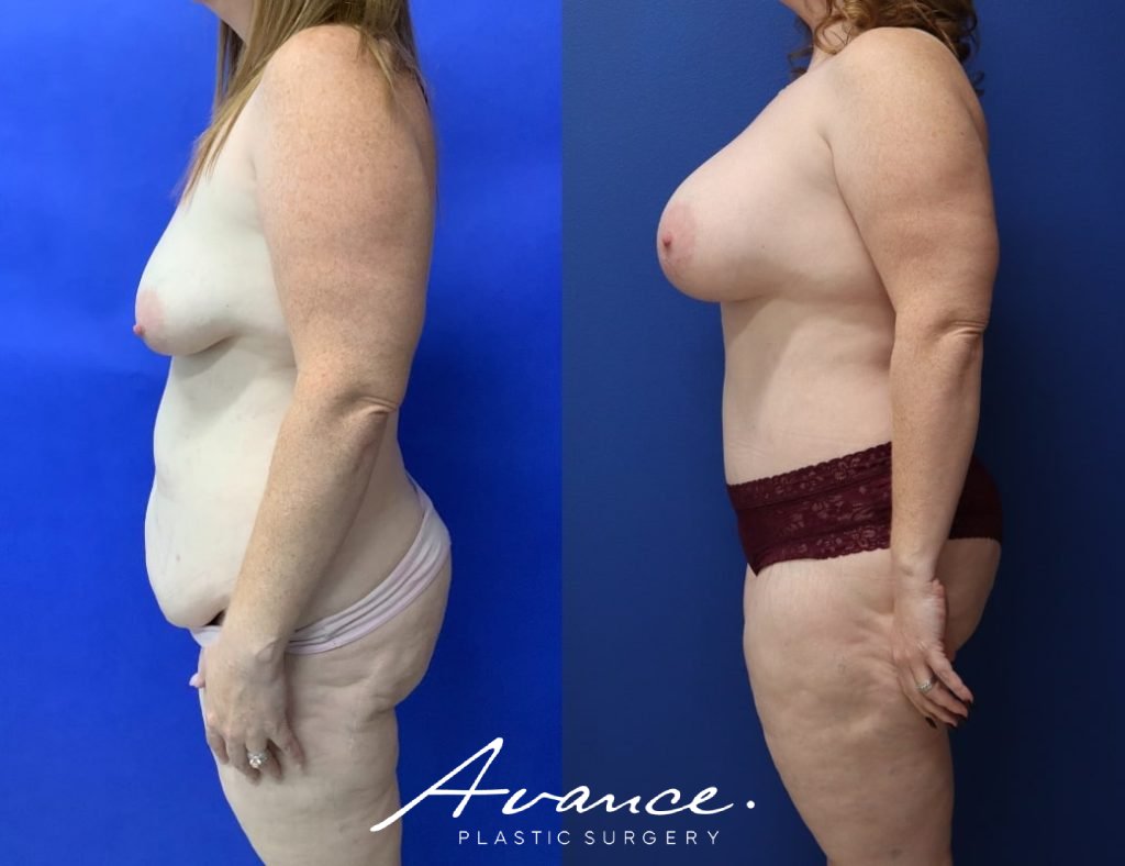 Before and After - Mommy Makeover