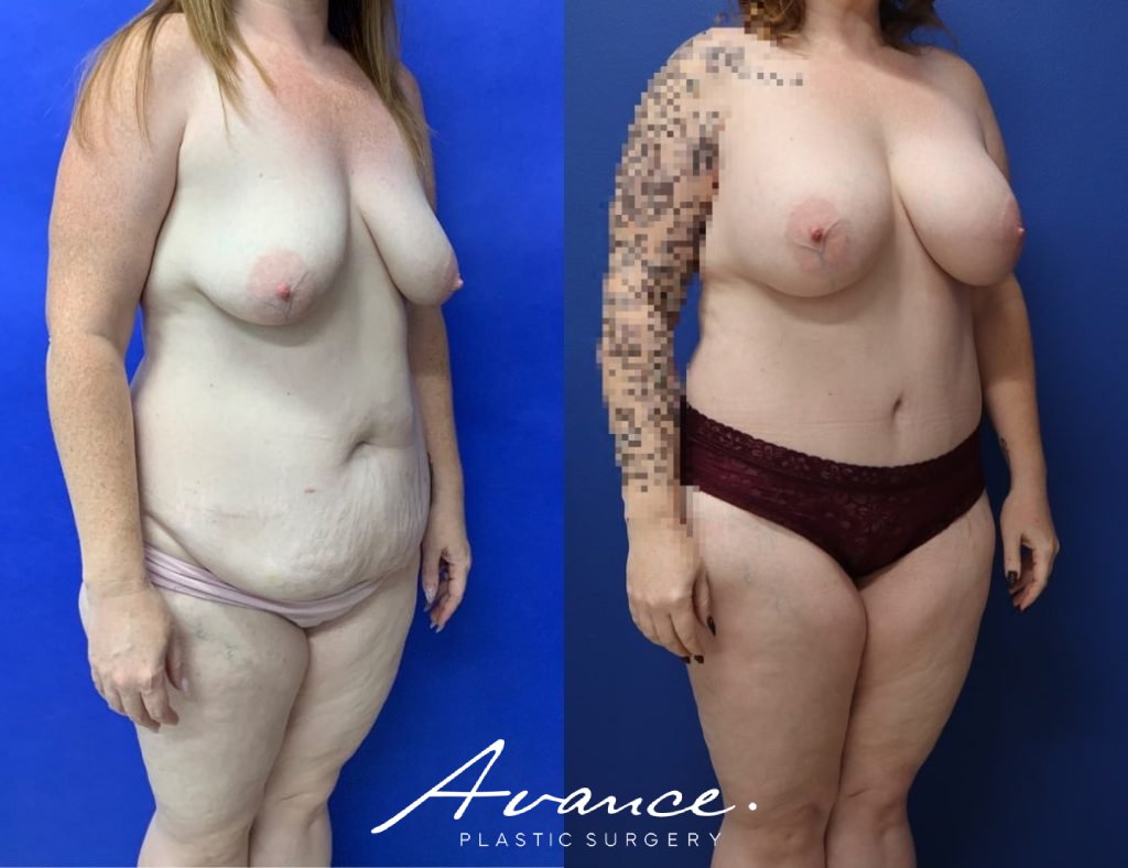 Before and After - Mommy Makeover