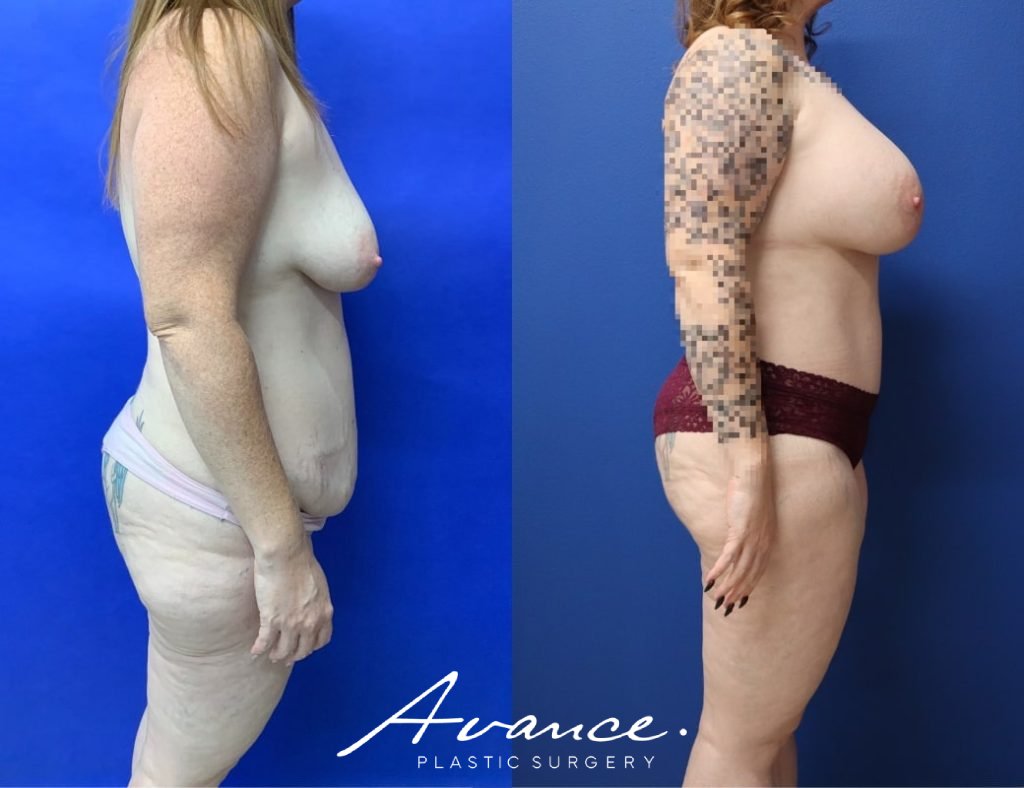 Before and After - Mommy Makeover
