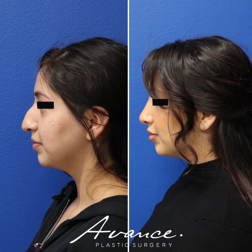 Before and After - Rhinoplasty