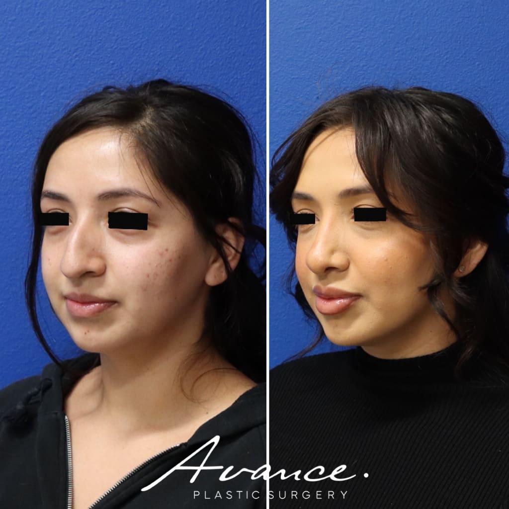 Before and After - Rhinoplasty