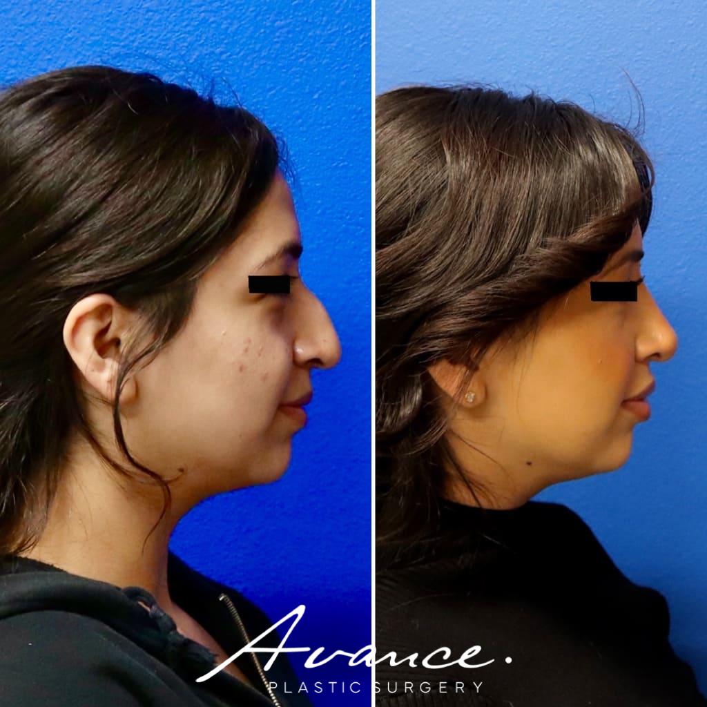Before and After - Rhinoplasty