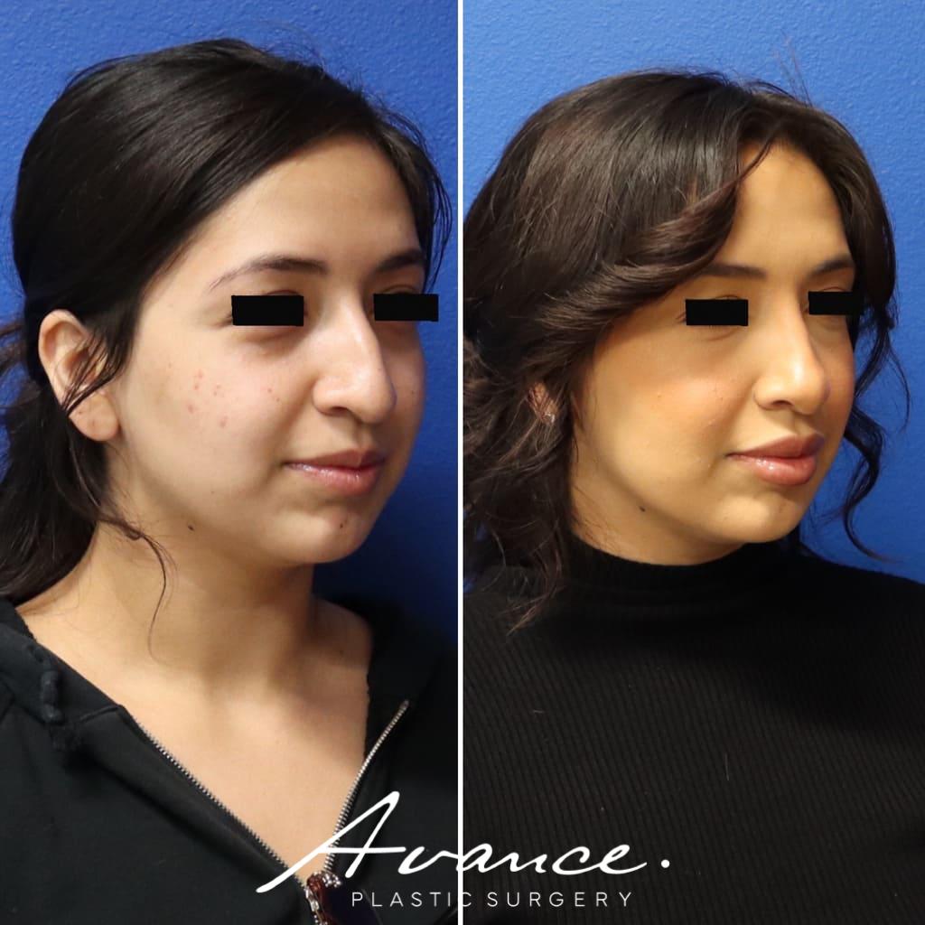Before and After - Rhinoplasty
