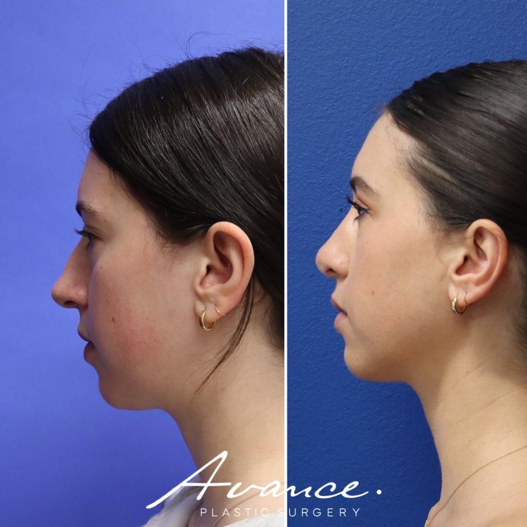 Before and After - Rhinoplasty