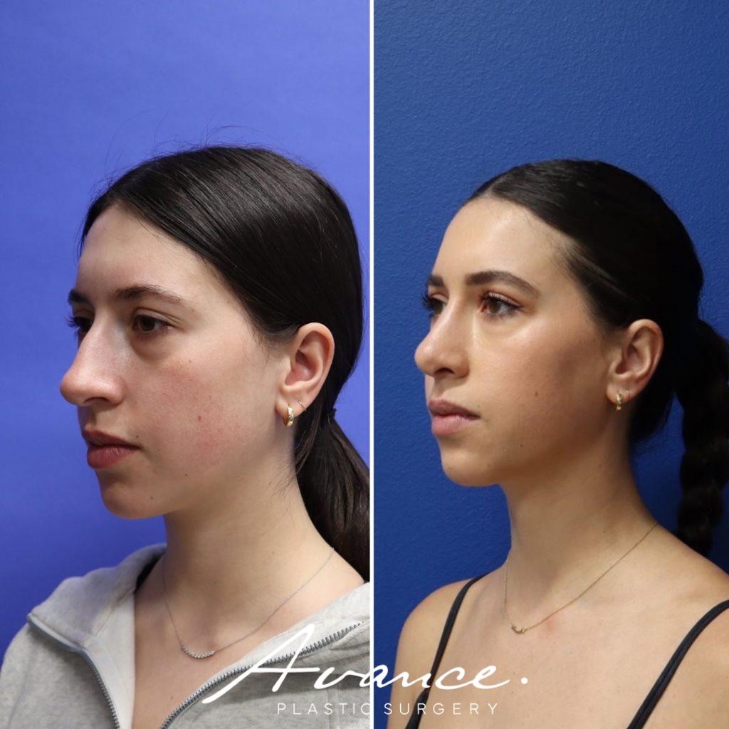 Before and After - Rhinoplasty
