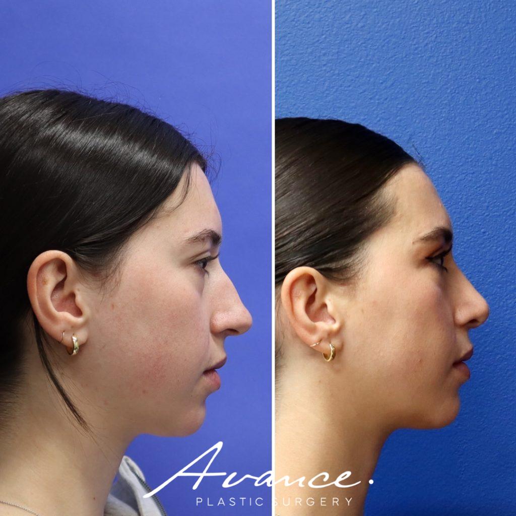 Before and After - Rhinoplasty