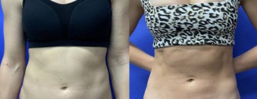 Before and After - 360 Liposuction