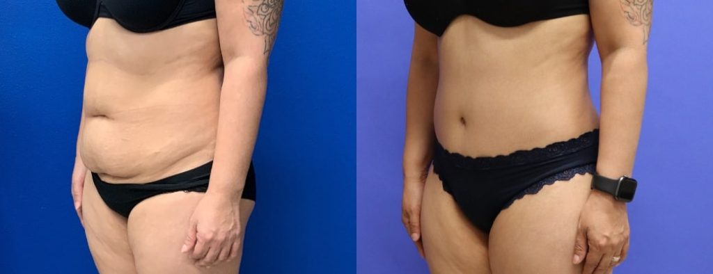 Before and After - Abdominoplastia