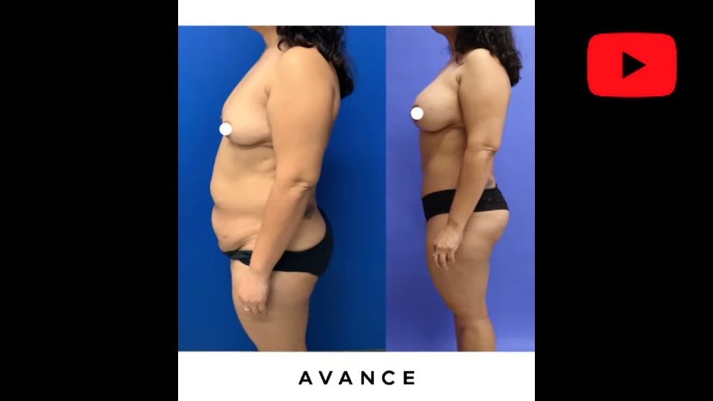 YouTube video titled Mommy Makeover/Breast Augmentation/Tummy Tuck/Abdominoplasty Reno/Tahoe
