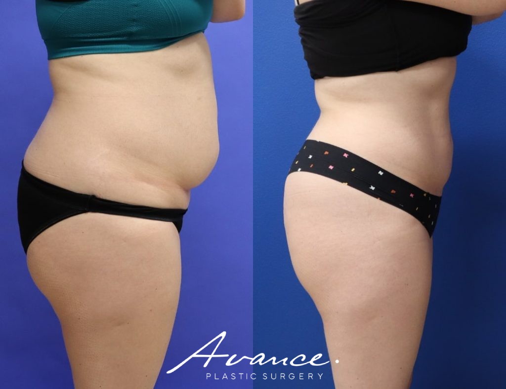 Before and After - Liposucción asistida por radiofrecuencia