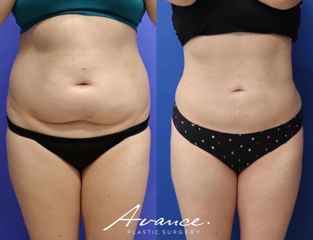 Before and After - 360 Liposucción