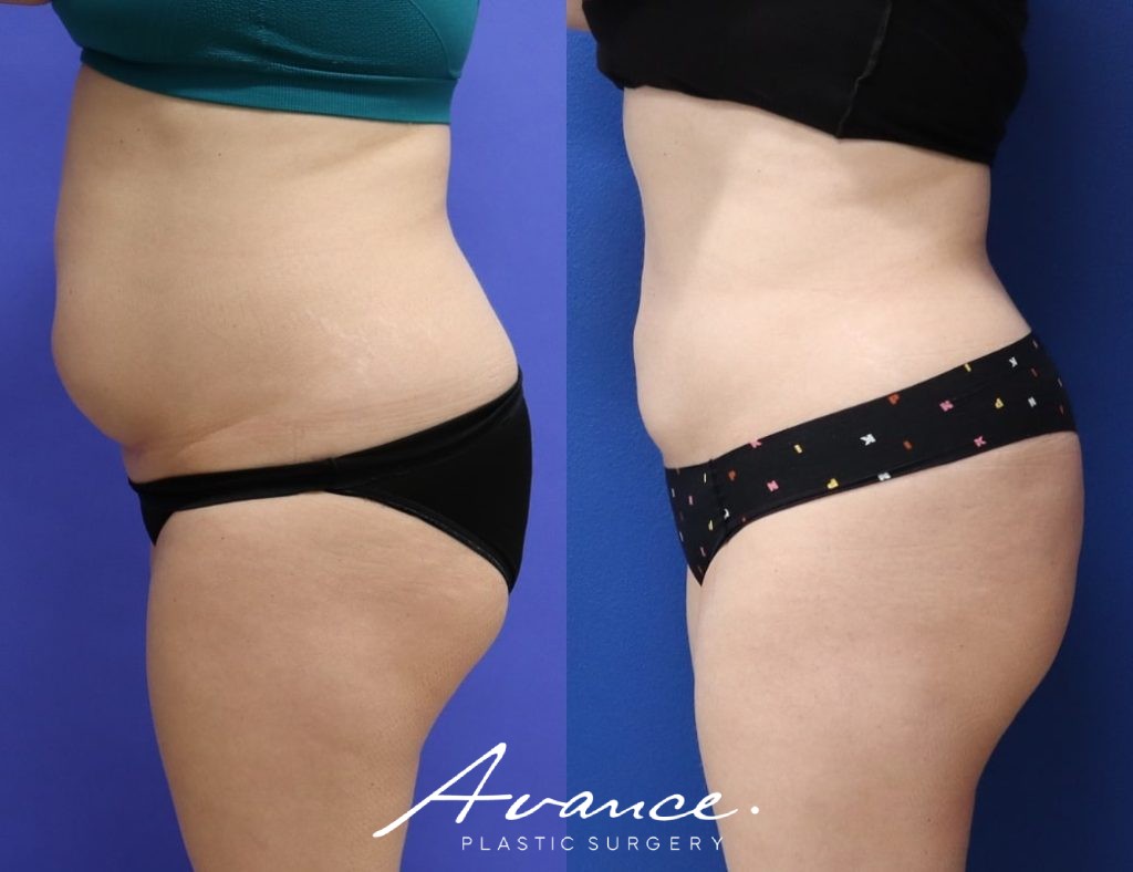 Before and After - 360 Liposucción