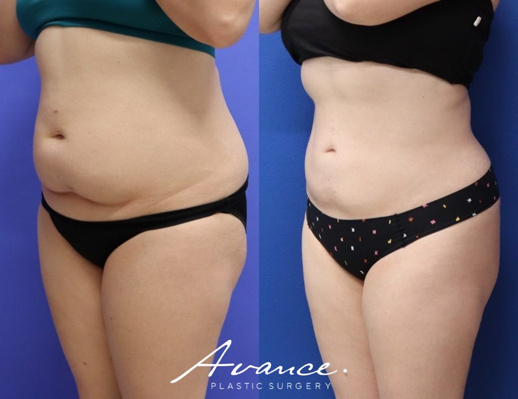 Before and After - 360 Liposucción