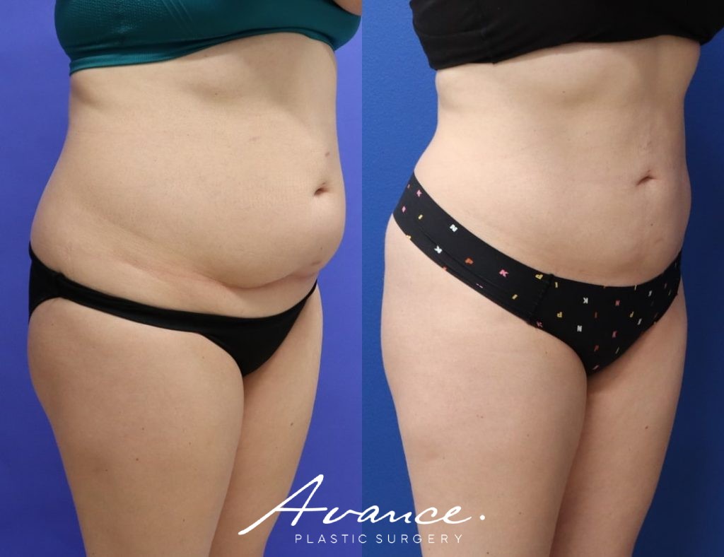 Before and After - 360 Liposucción