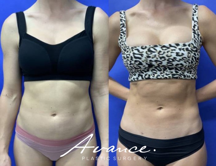 Before and After - 360 Liposucción