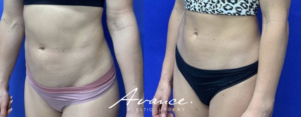Before and After - 360 Liposucción