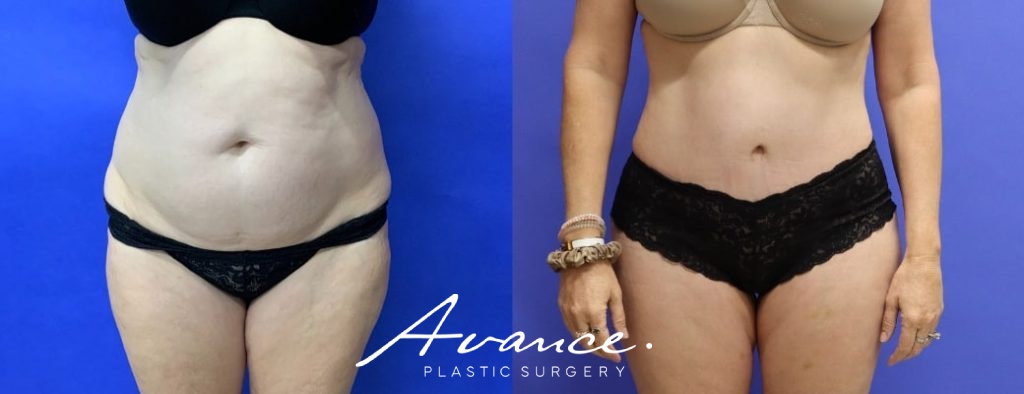 Before and After - Abdominoplasty