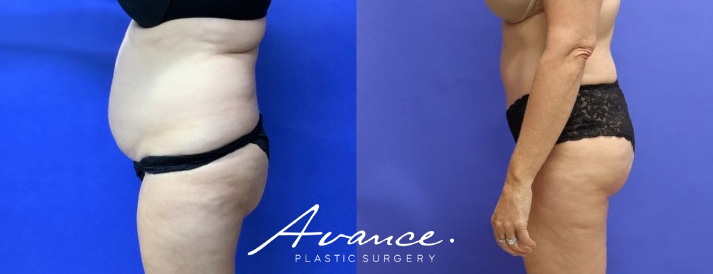 Before and After - Abdominoplasty