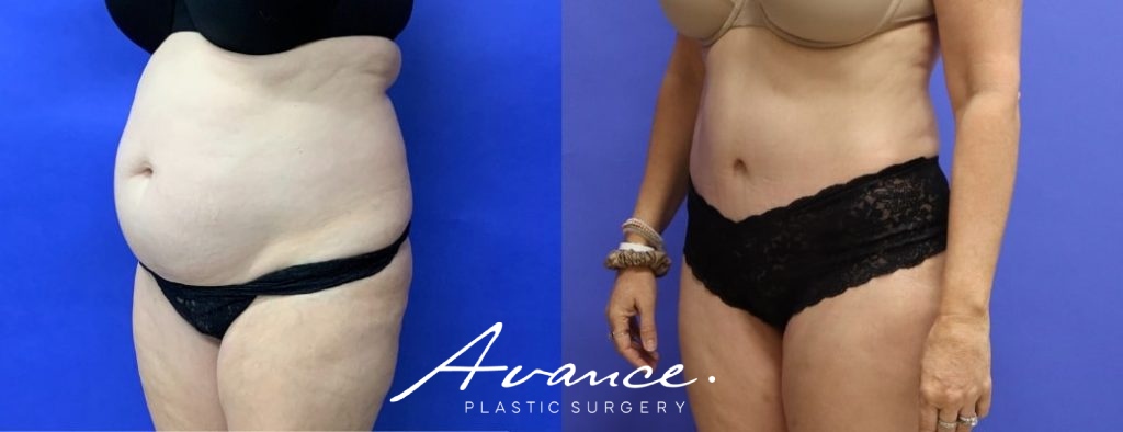 Before and After - Abdominoplasty