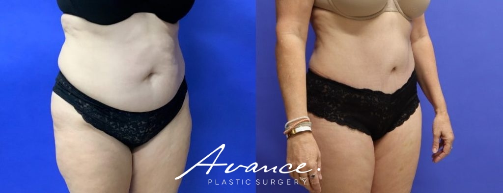 Before and After - Abdominoplasty